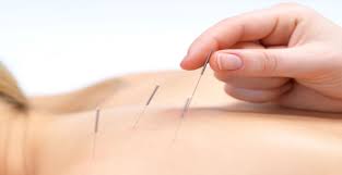 acupunc
