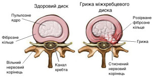 hernia