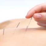 acupunc